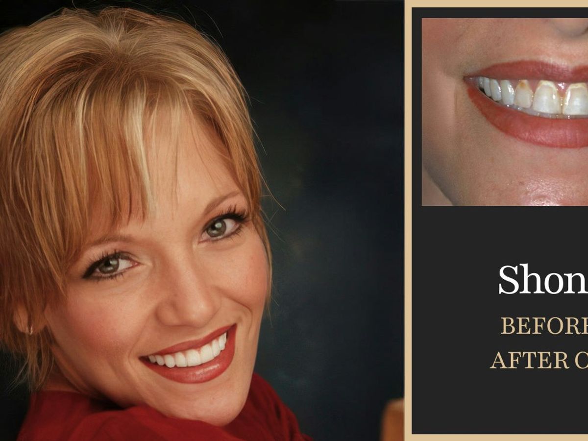 Before and after — veneers and crowns
