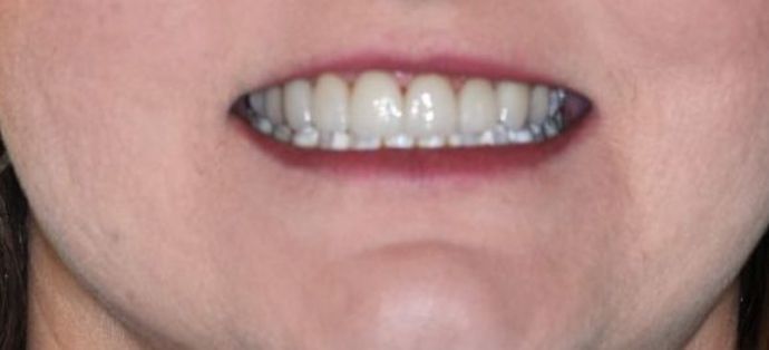 Dental Crowns: Case 17 — after