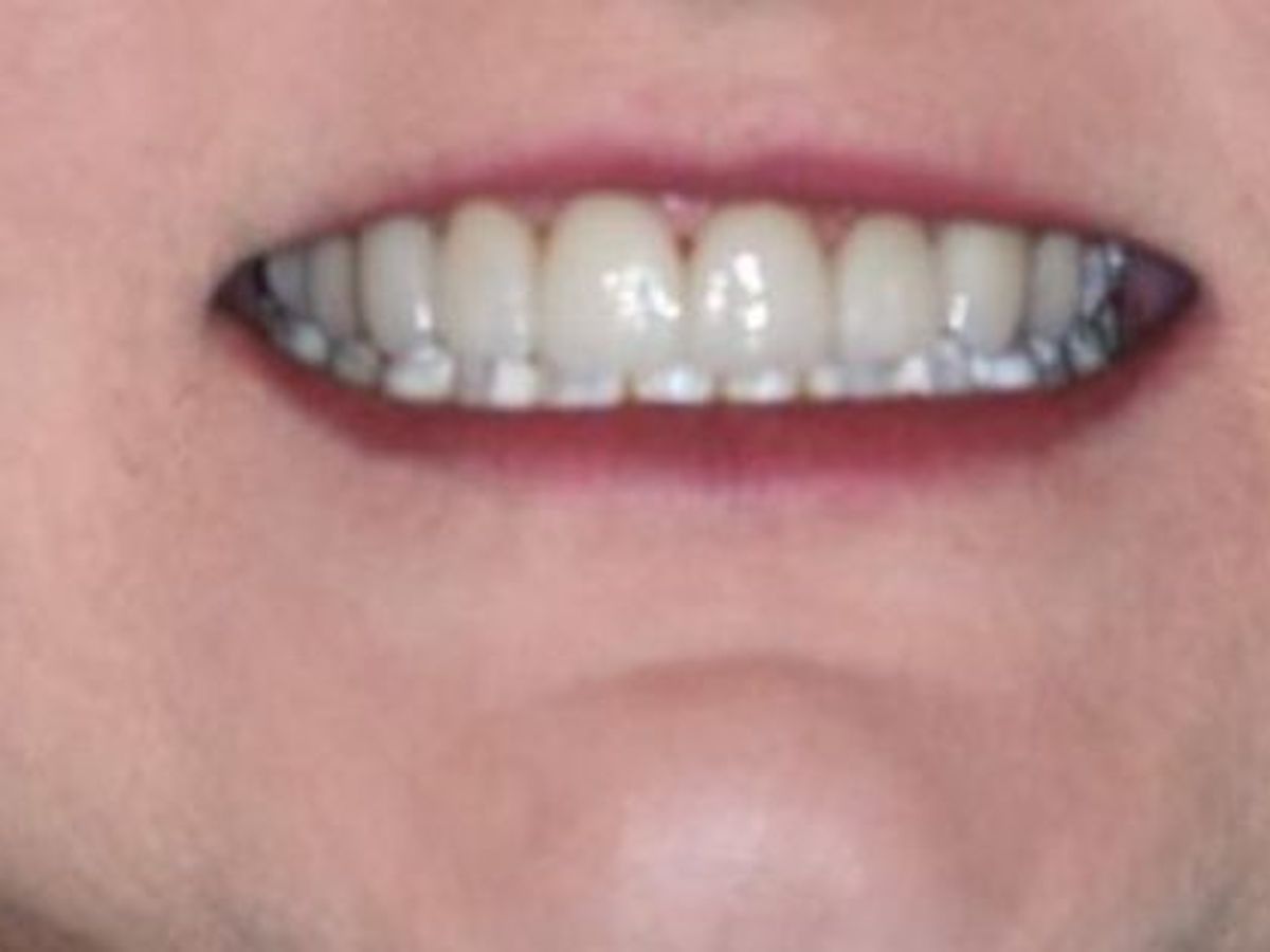 Dental Crowns: Case 17 — after
