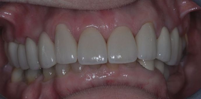 Dental Crowns: Case 19 — after
