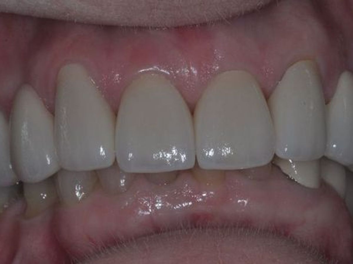 Dental Crowns: Case 19 — after