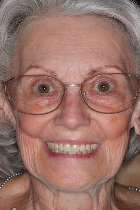 Dentures: Case 12 — after
