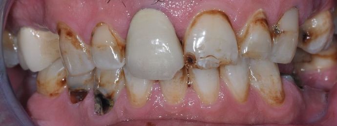 Dental Crowns: Case 21 — before