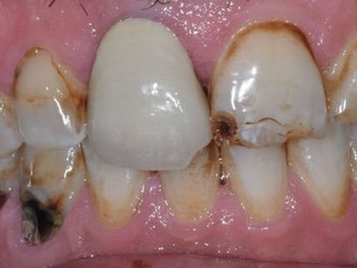 Dental Crowns: Case 21 — before