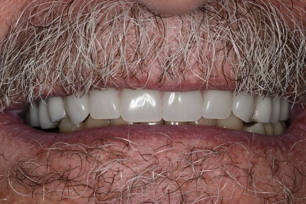 Dentures: Case 4 — after