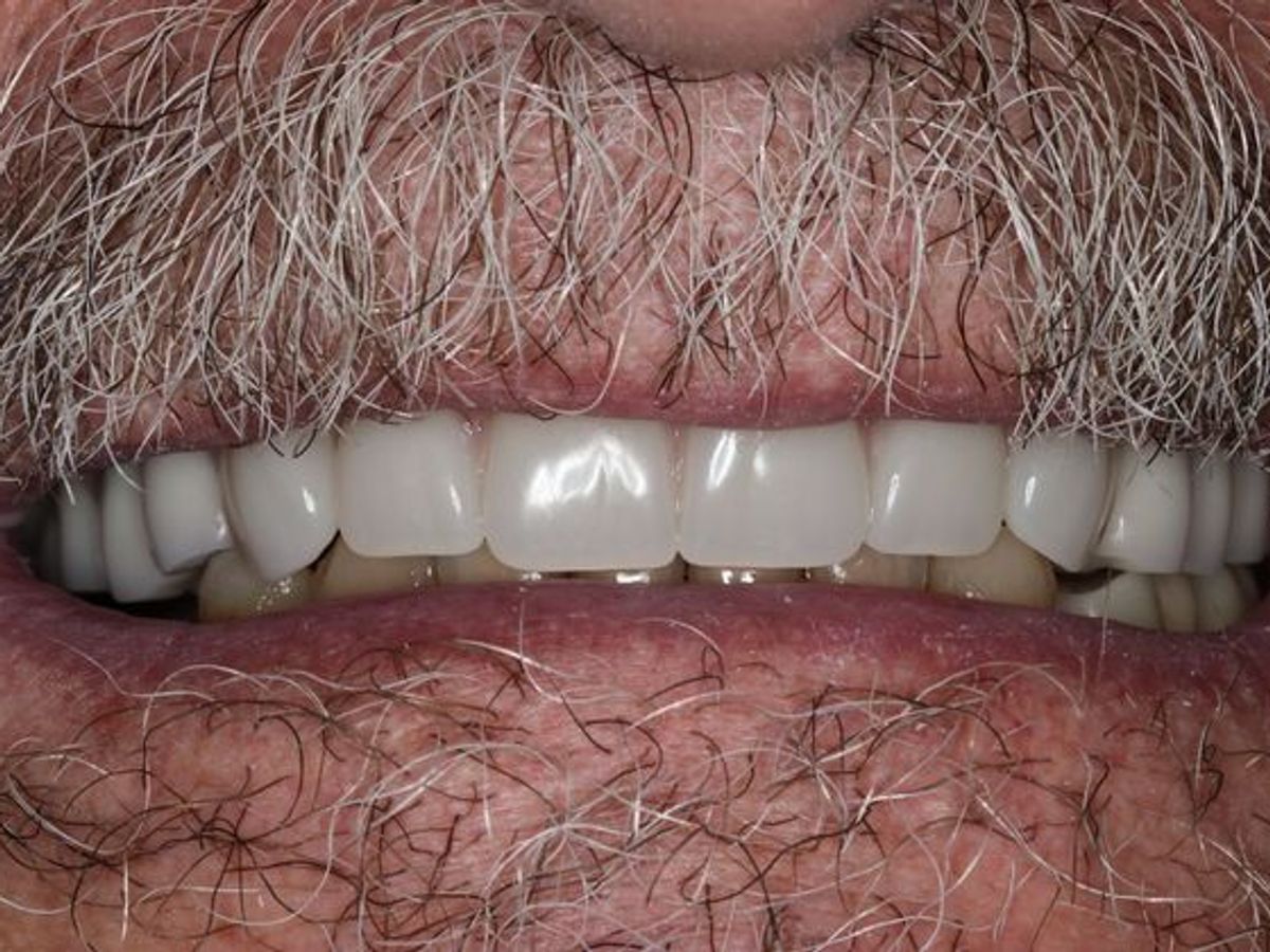 Dentures: Case 4 — after
