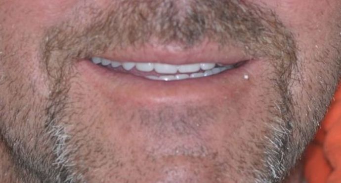 Dentures: Case 1 - after