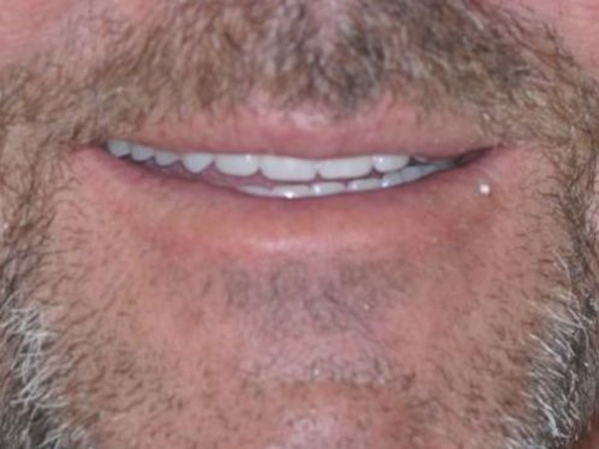 Dentures: Case 1 — after