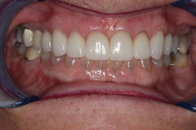 Veneers: Case 6 — after