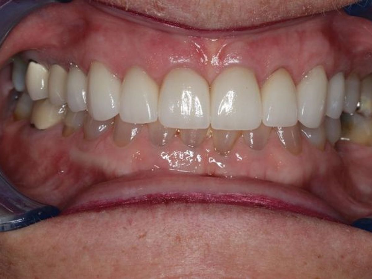Veneers: Case 6 — after