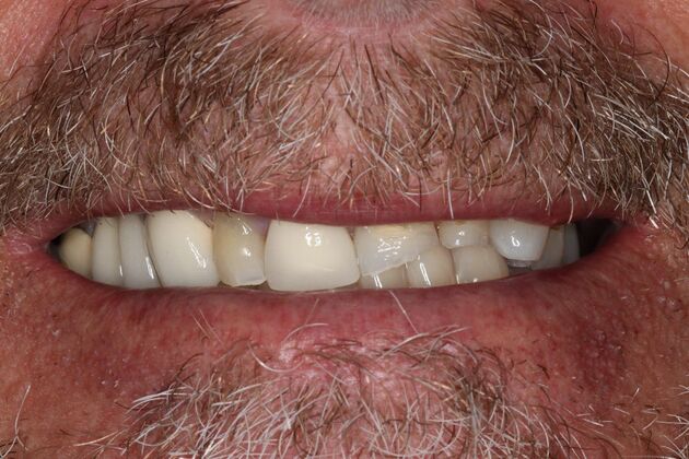 Full Mouth Reconstruction: Case 9 — before
