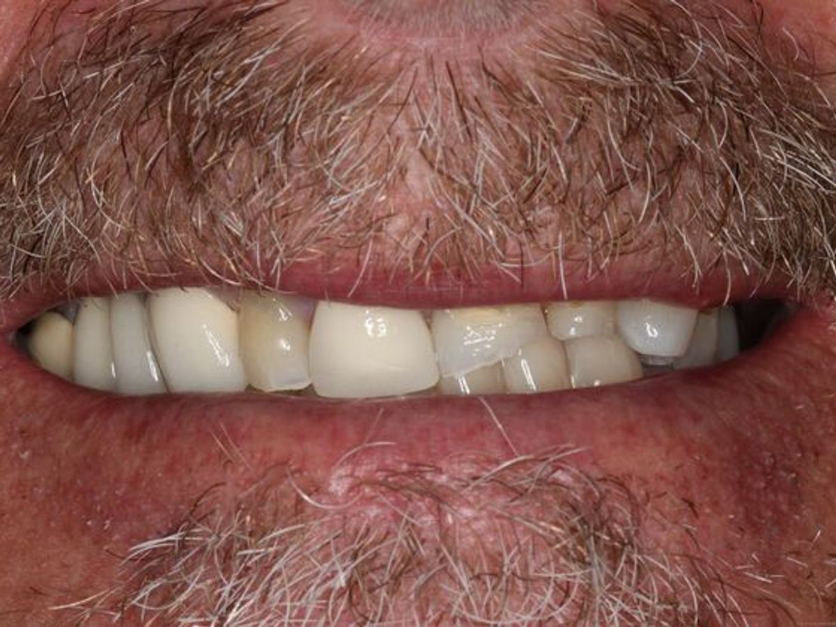 Full Mouth Reconstruction: Case 9 — before