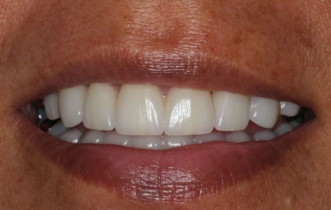 Veneers: Case 16 — after