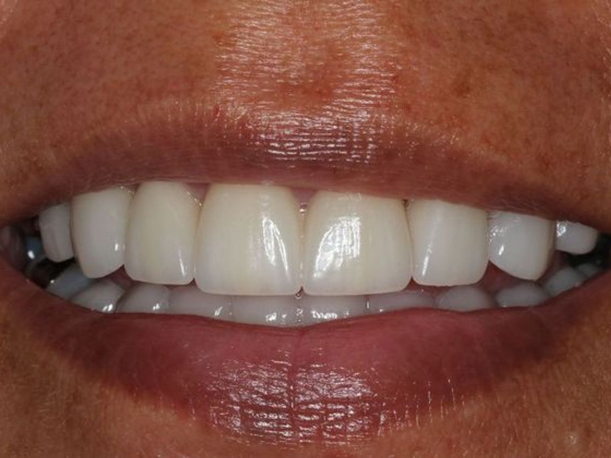 Veneers: Case 16 — after