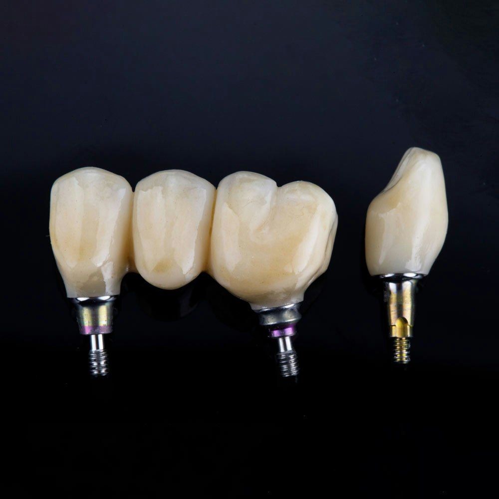 Implant-supported crowns