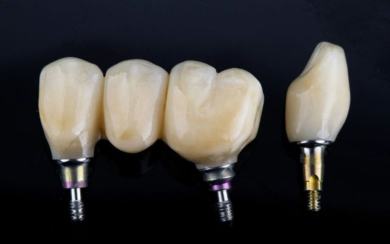Implant-supported crowns
