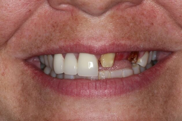 Dental Crowns: Case 34 — before