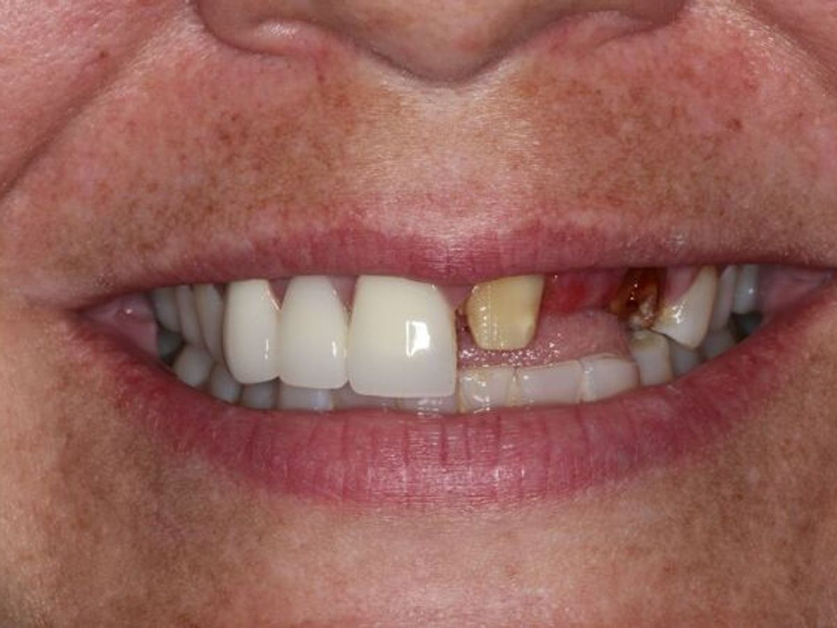 Dental Crowns: Case 34 — before