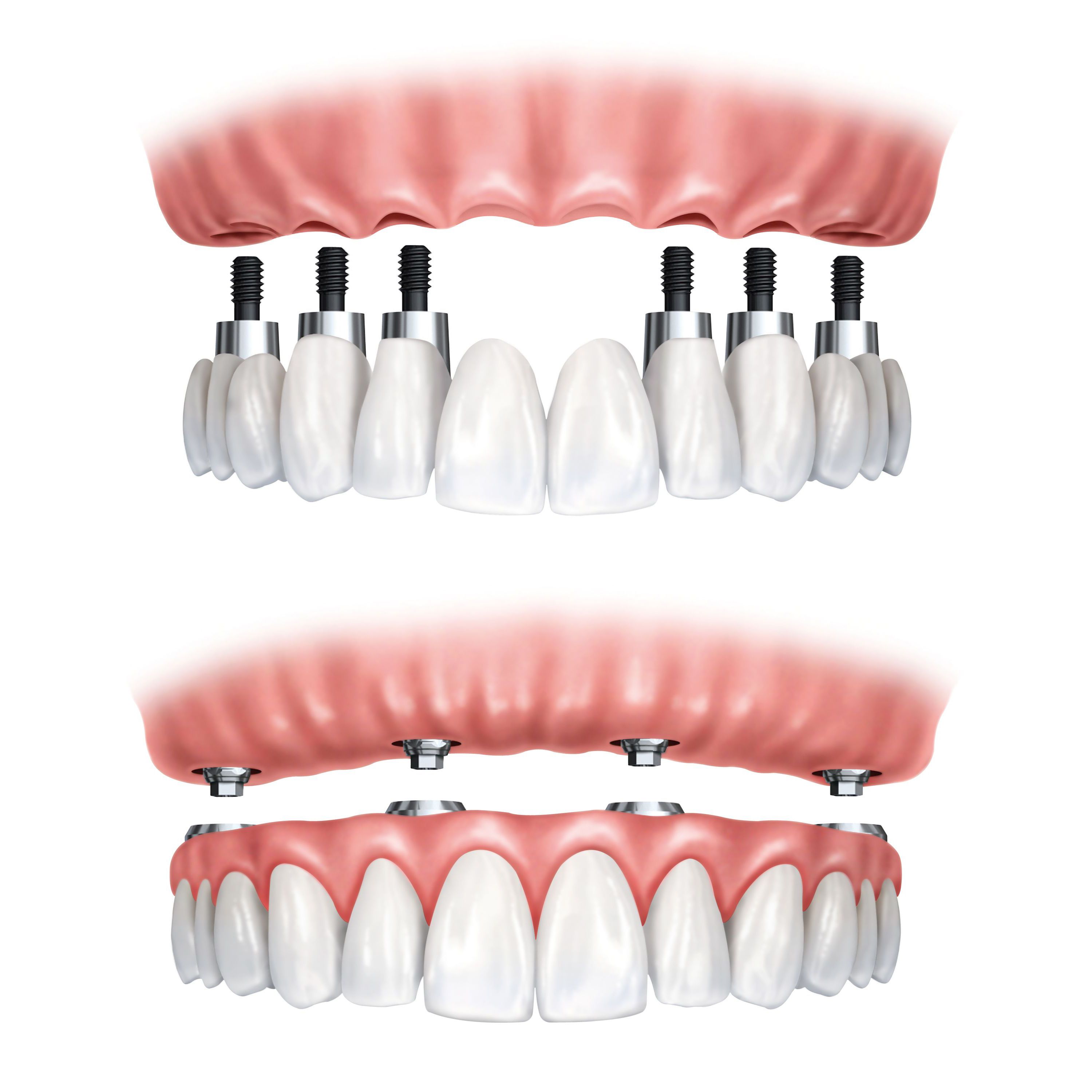 All-on-Four vs. Traditional Dental Implants