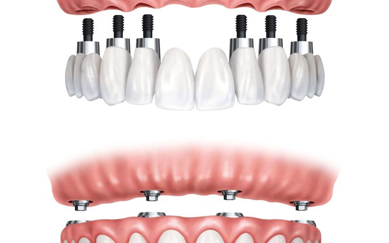 All-on-Four vs. Traditional Dental Implants