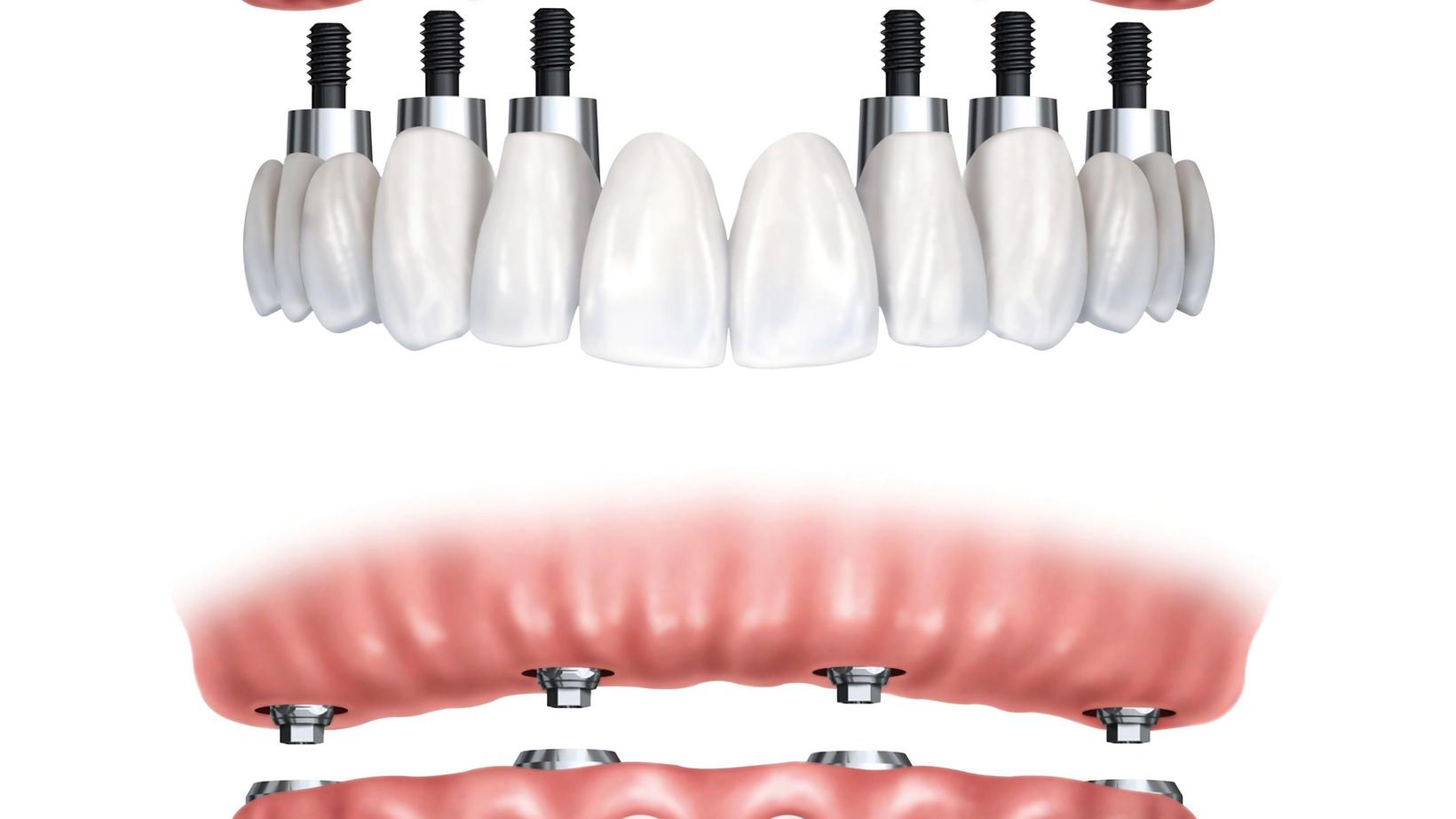 All-on-Four vs. Traditional Dental Implants