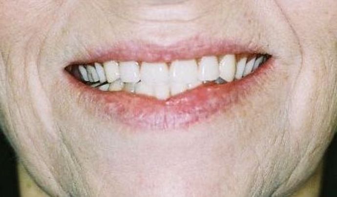 Dentures: Case 2 — before