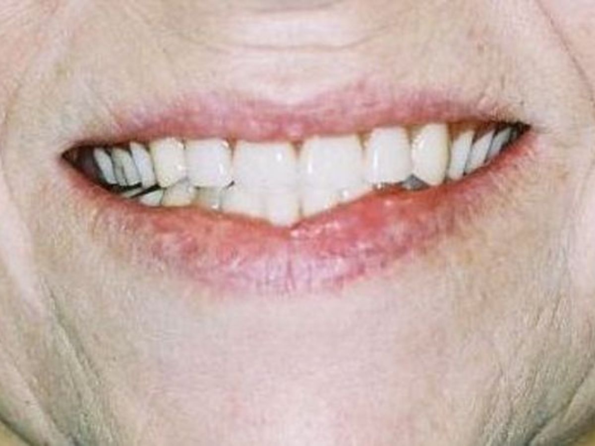 Dentures: Case 2 — before
