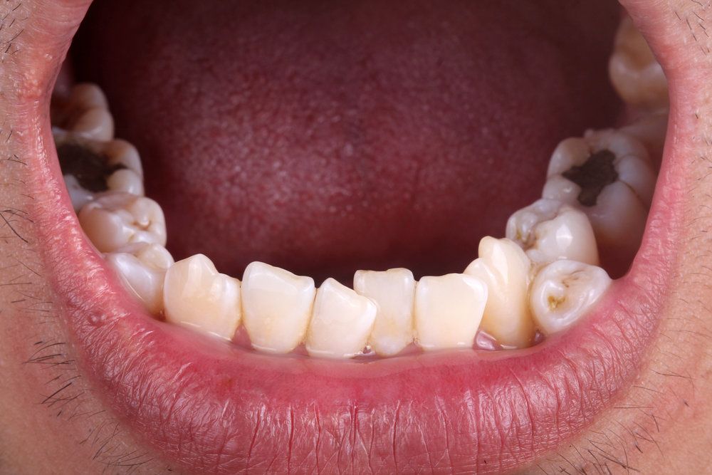 Treatment for Hyperdontia, or Extra Teeth