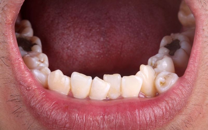 Treatment for Hyperdontia, or Extra Teeth