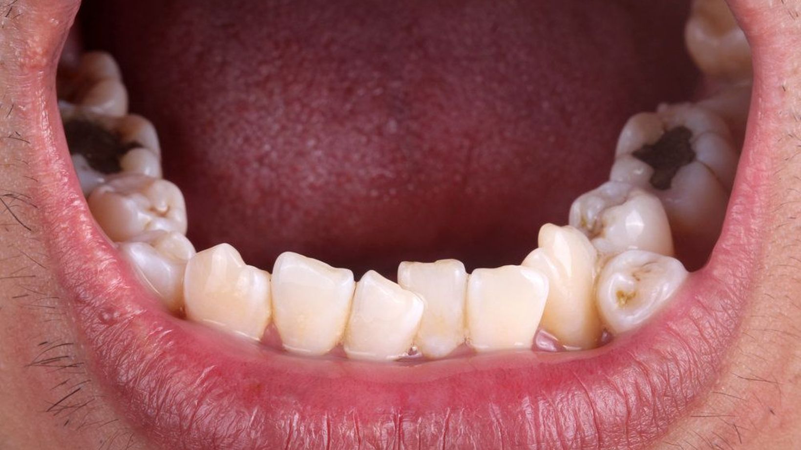 Treatment for Hyperdontia, or Extra Teeth
