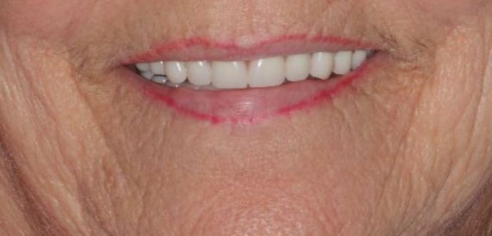 Dentures: Case 6 — after