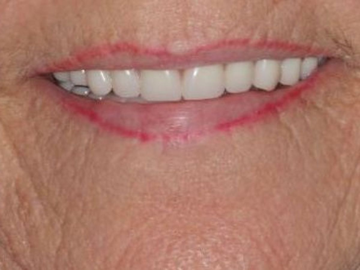 Dentures: Case 6 — after
