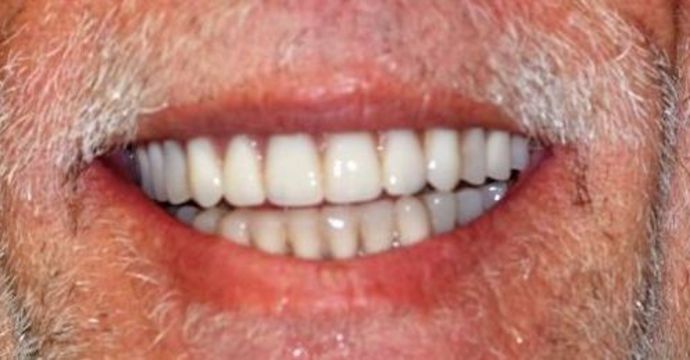 Teeth in a Day: Case 17 — after