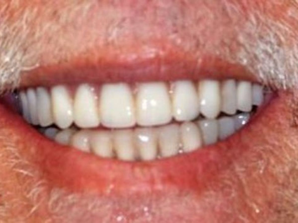 Teeth in a Day: Case 17 — after