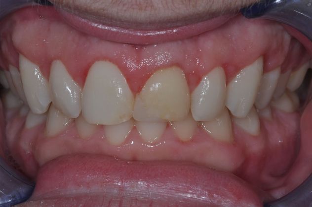 Gum Lift: Case 4/609 — after
