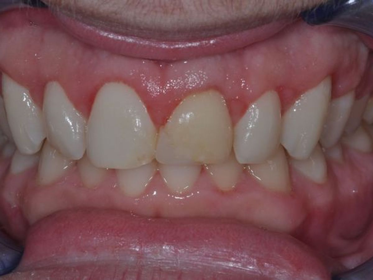 Gum Lift: Case 4/609 — after