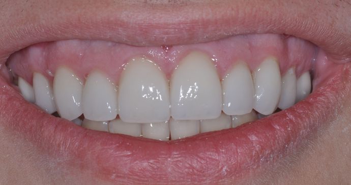 Dental Crowns: Case 2 — after