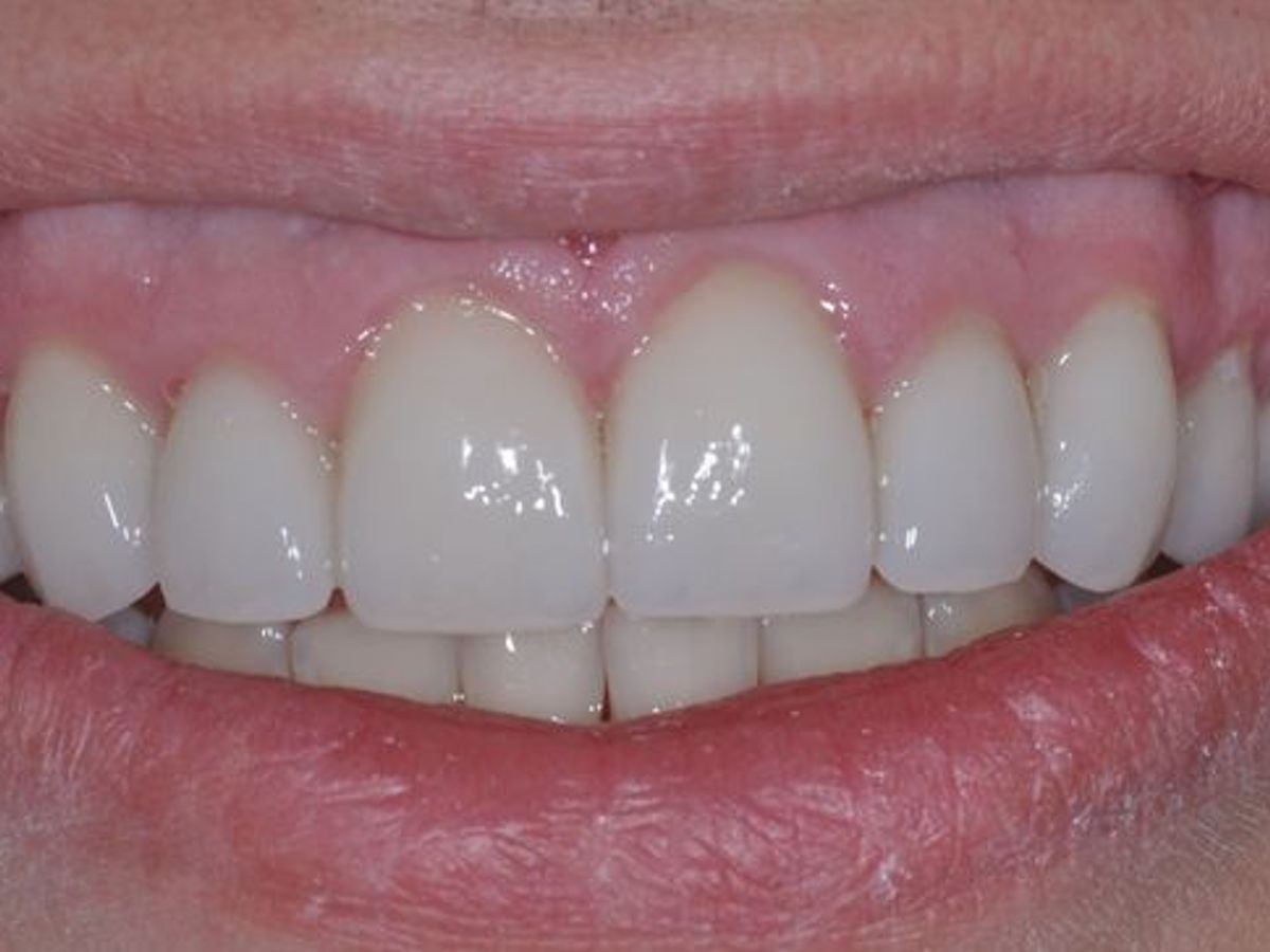 Dental Crowns: Case 2 — after