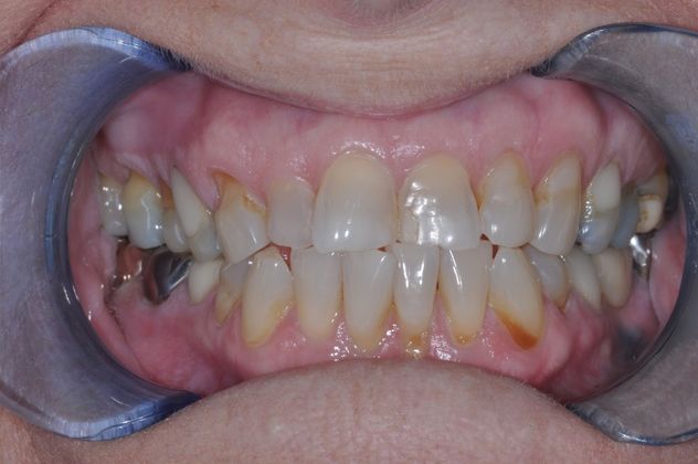 Dental Crowns: Case 3 — before
