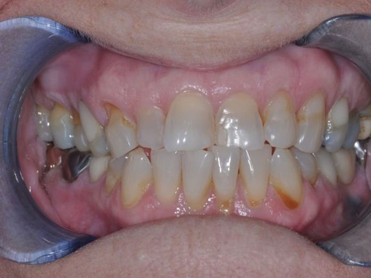 Dental Crowns: Case 3 — before