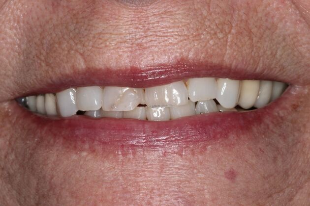 Dentures: Case 15 — Upper Crowns and Partial before
