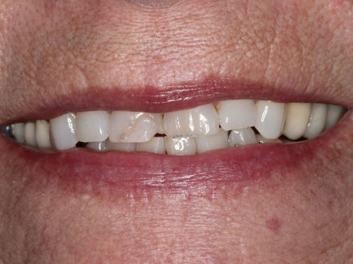Dentures: Case 15 — Upper Crowns and Partial before
