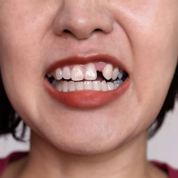 woman with missing tooth
