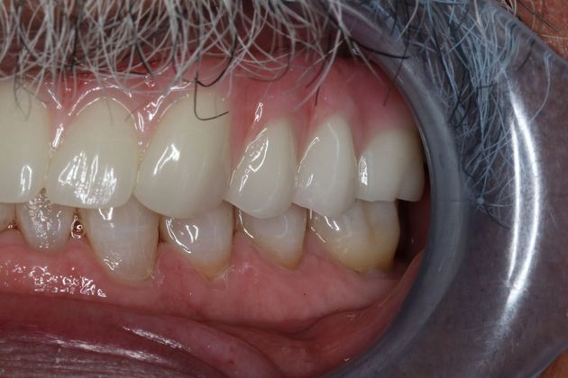 Teeth in a Day: Case 3 — Upper Arch after