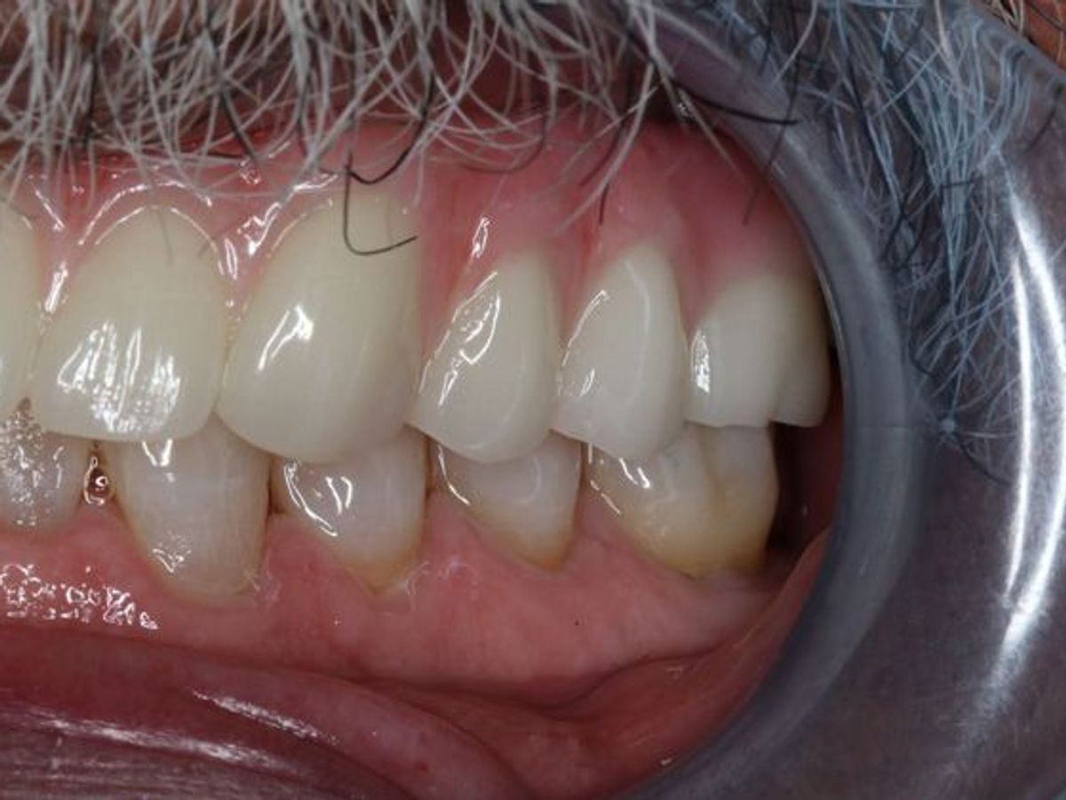 Teeth in a Day: Case 3 — Upper Arch after