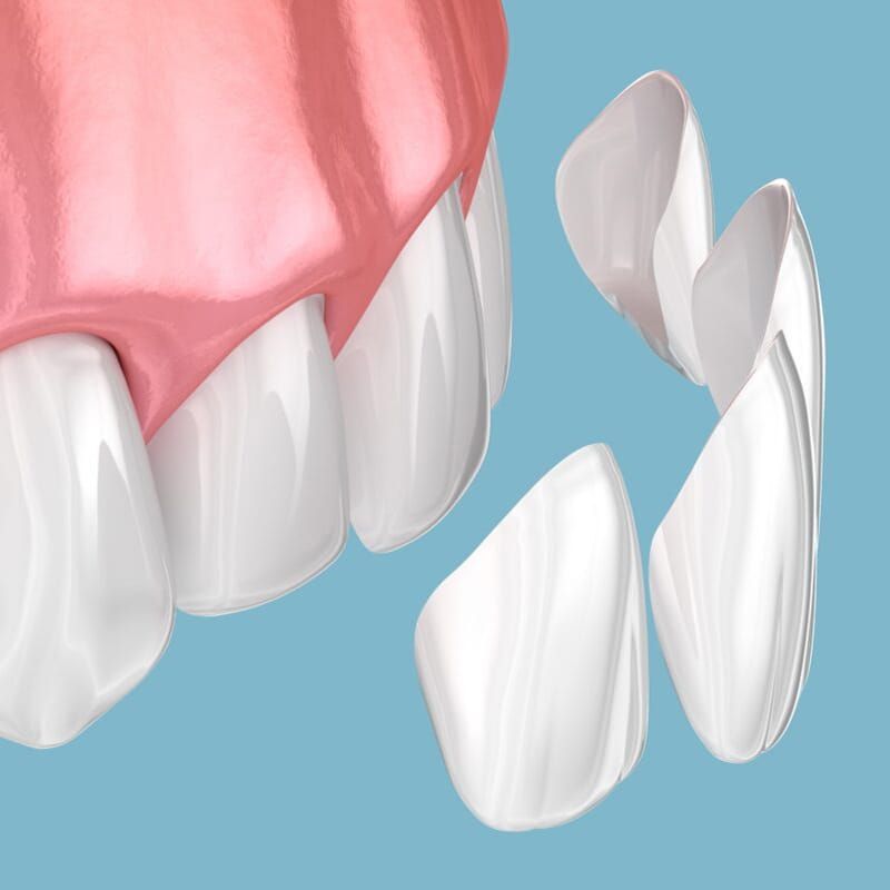 Porcelain dental veneers in Jackson, Mississippi.