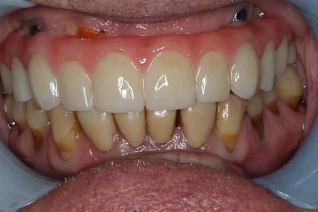 Teeth in a Day: Case 2 — Upper Arch after