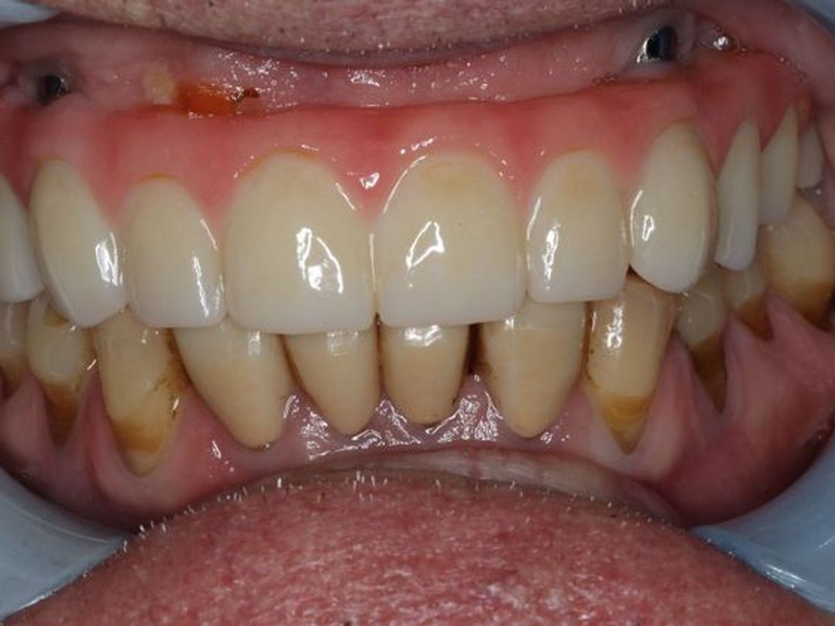 Teeth in a Day: Case 2 — Upper Arch after