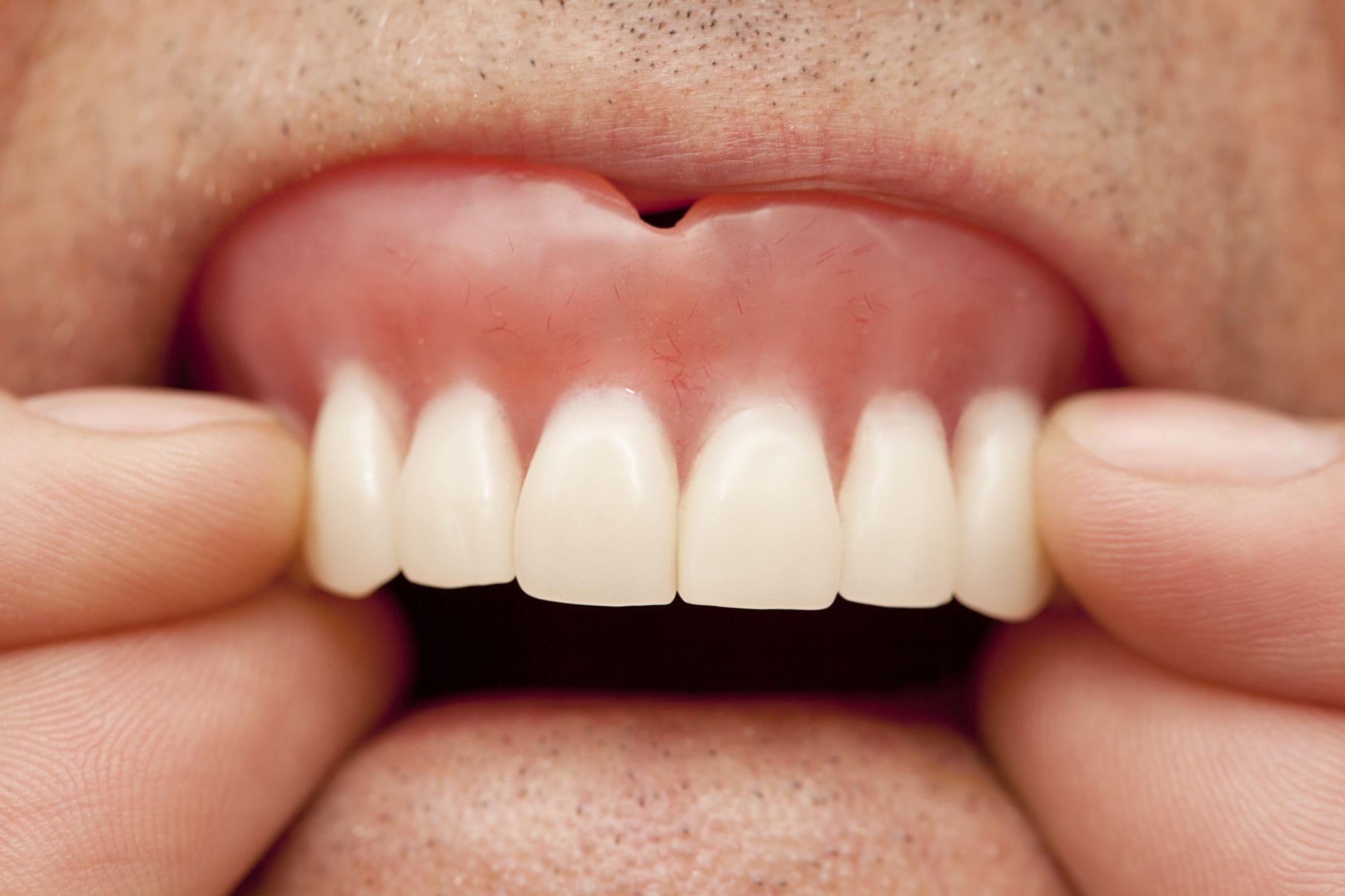 Signs Your Dentures Need to Be Replaced