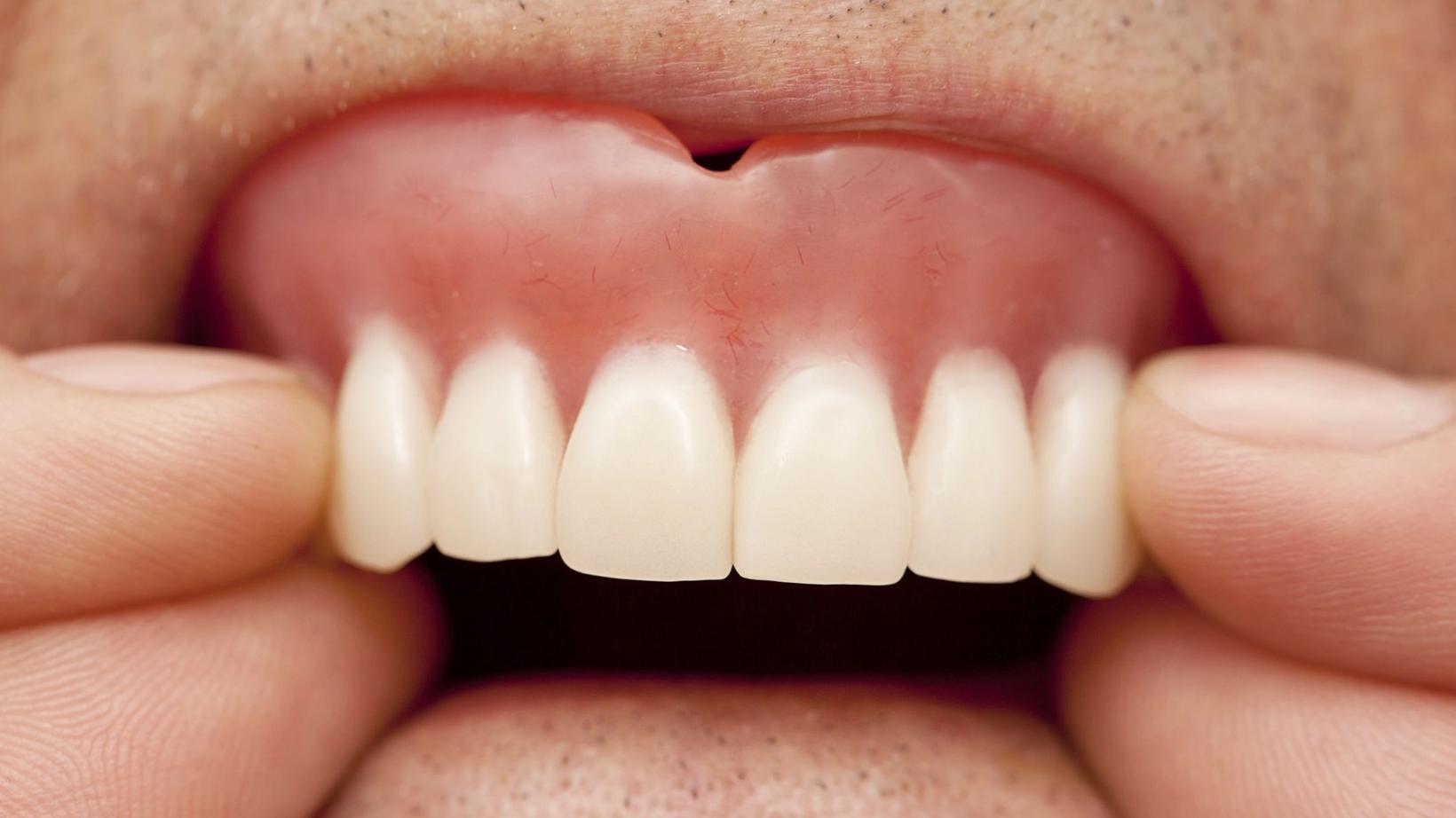 Signs Your Dentures Need to Be Replaced
